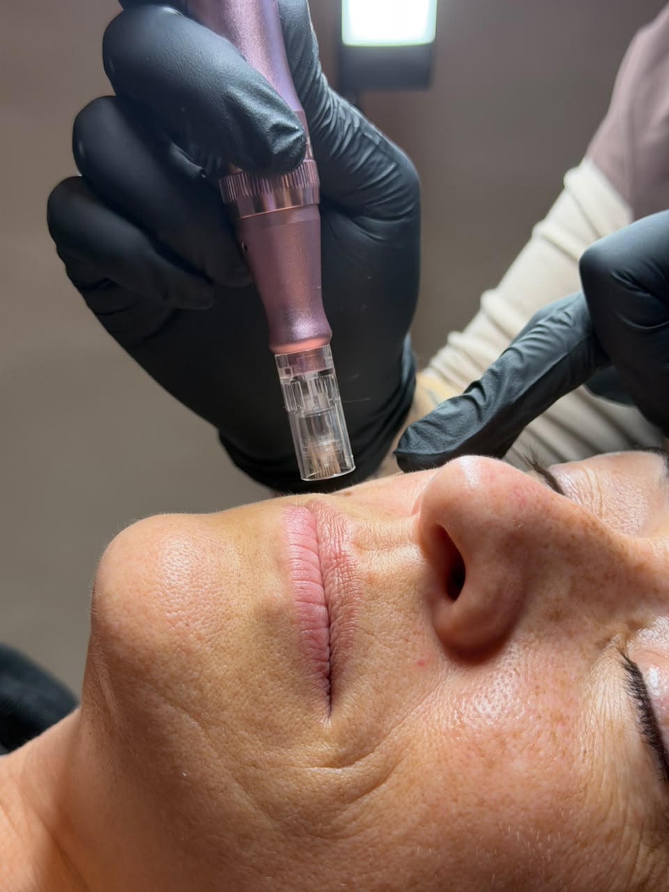 Microneedling